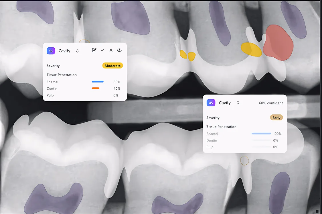 Dental bitewing radiograph with AI detection overlays